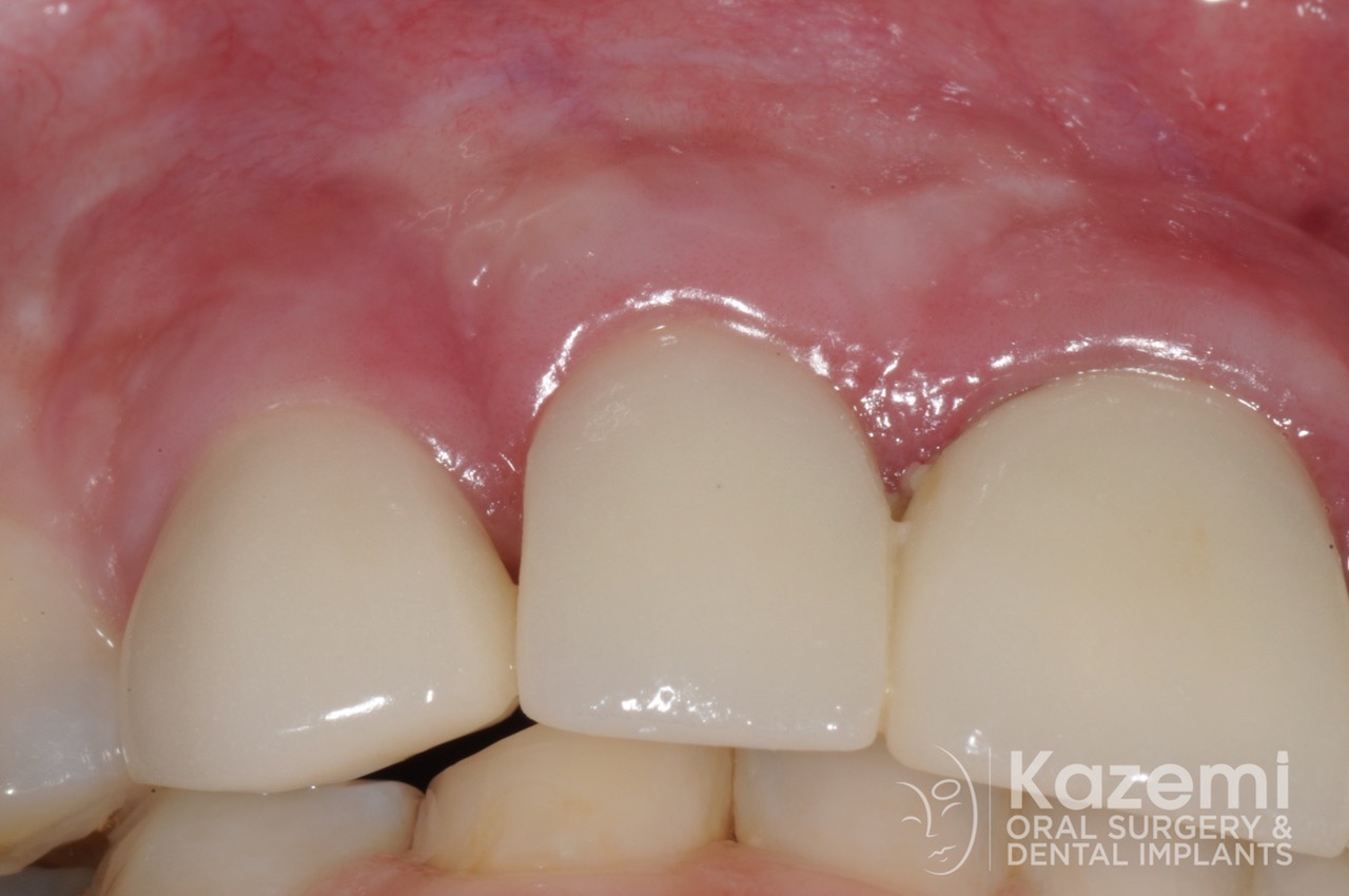 18dental implant complication kazemi oral surgery