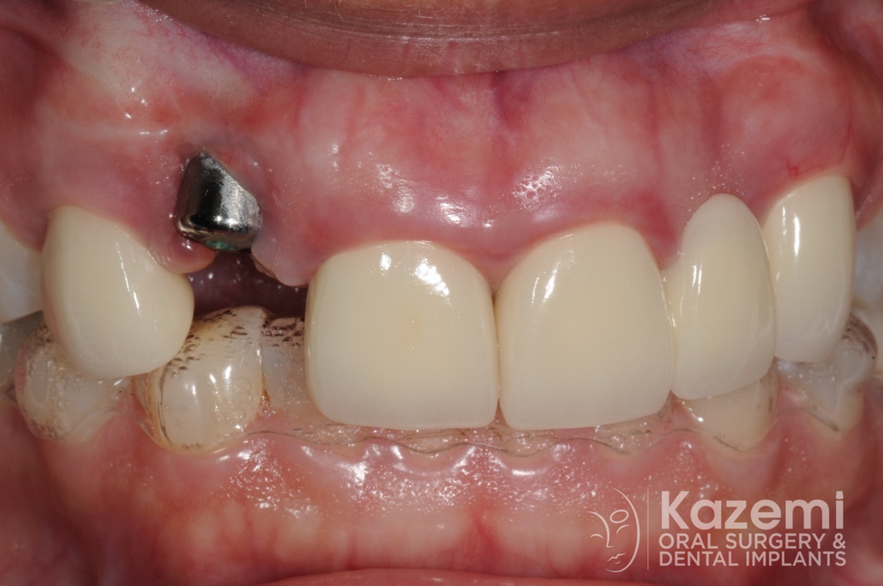 1dental implant complication kazemi oral surgery