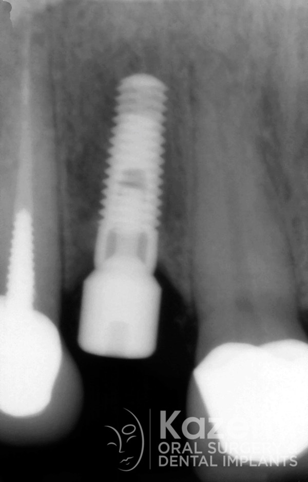 3dental implant complication kazemi oral surgery