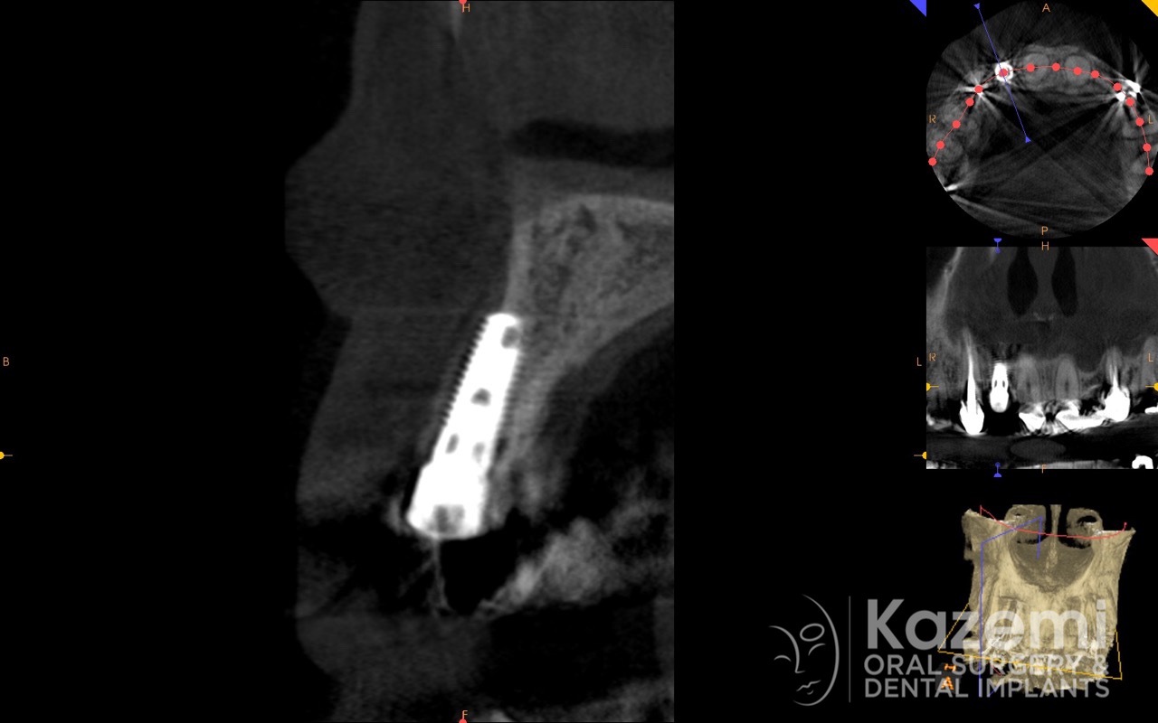4dental implant complication kazemi oral surgery