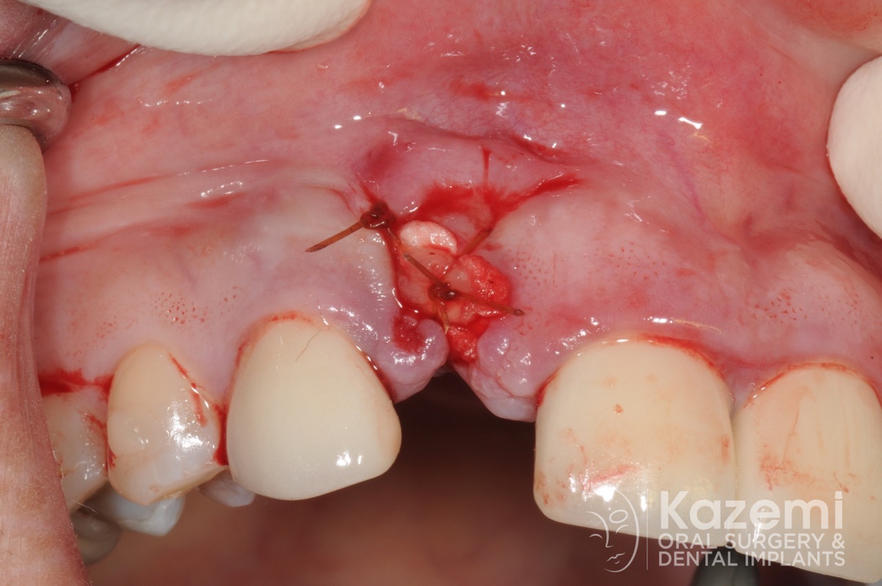 6dental implant complication kazemi oral surgery