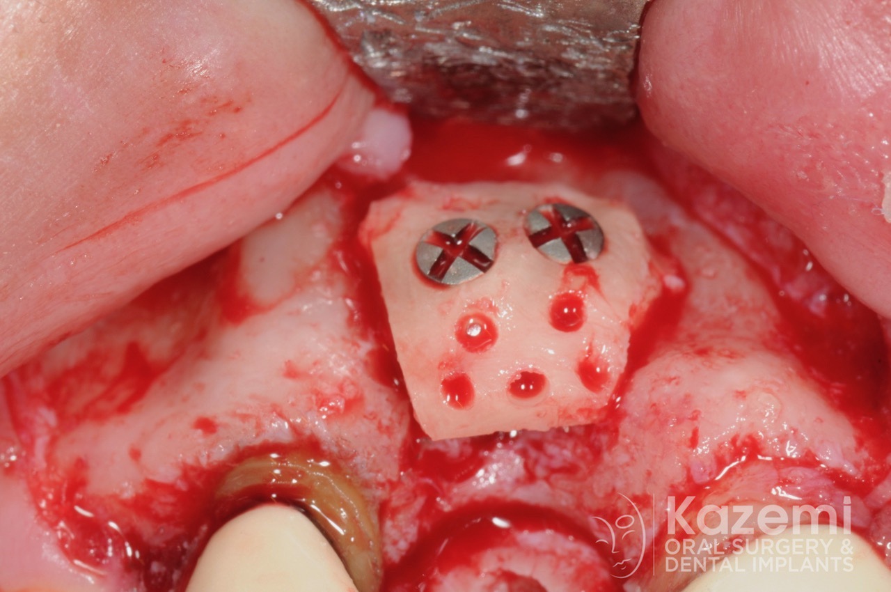 8dental implant complication kazemi oral surgery