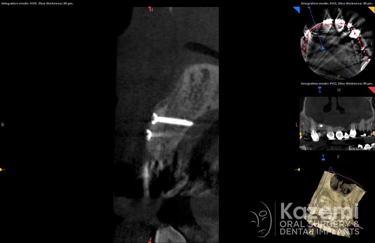 9dental implant complication kazemi oral surgery