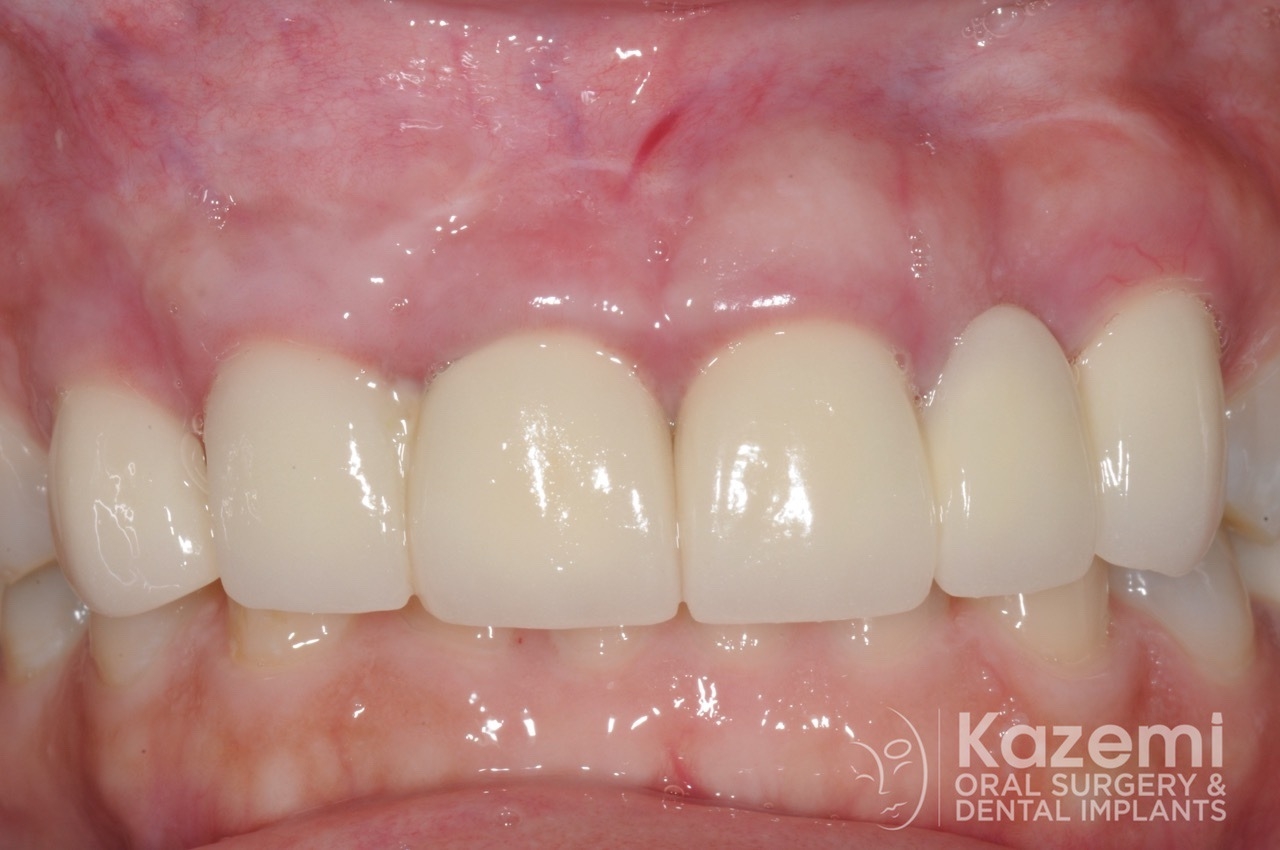 17dental implant complication kazemi oral surgery