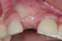 10dental implant complication kazemi oral surgery
