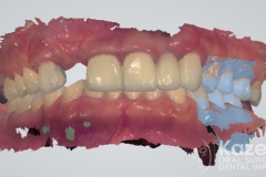 11dental implant complication kazemi oral surgery