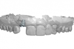13dental implant complication kazemi oral surgery
