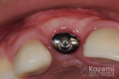 14dental implant complication kazemi oral surgery
