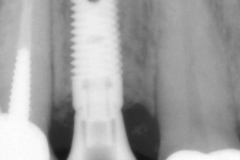 16dental implant complication kazemi oral surgery