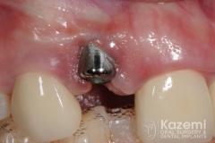 2dental implant complication kazemi oral surgery