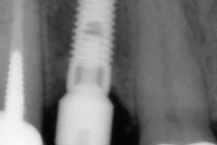 3dental implant complication kazemi oral surgery