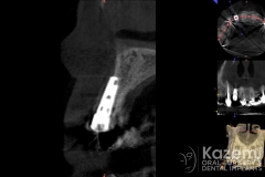 4dental implant complication kazemi oral surgery