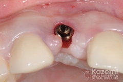 5dental implant complication kazemi oral surgery