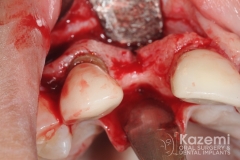 7dental implant complication kazemi oral surgery