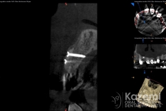 9dental implant complication kazemi oral surgery