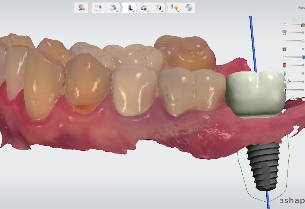 1.-Molar-dental-implant-digital-dentistry-kazemi-oral-surgery-bethesda-MD