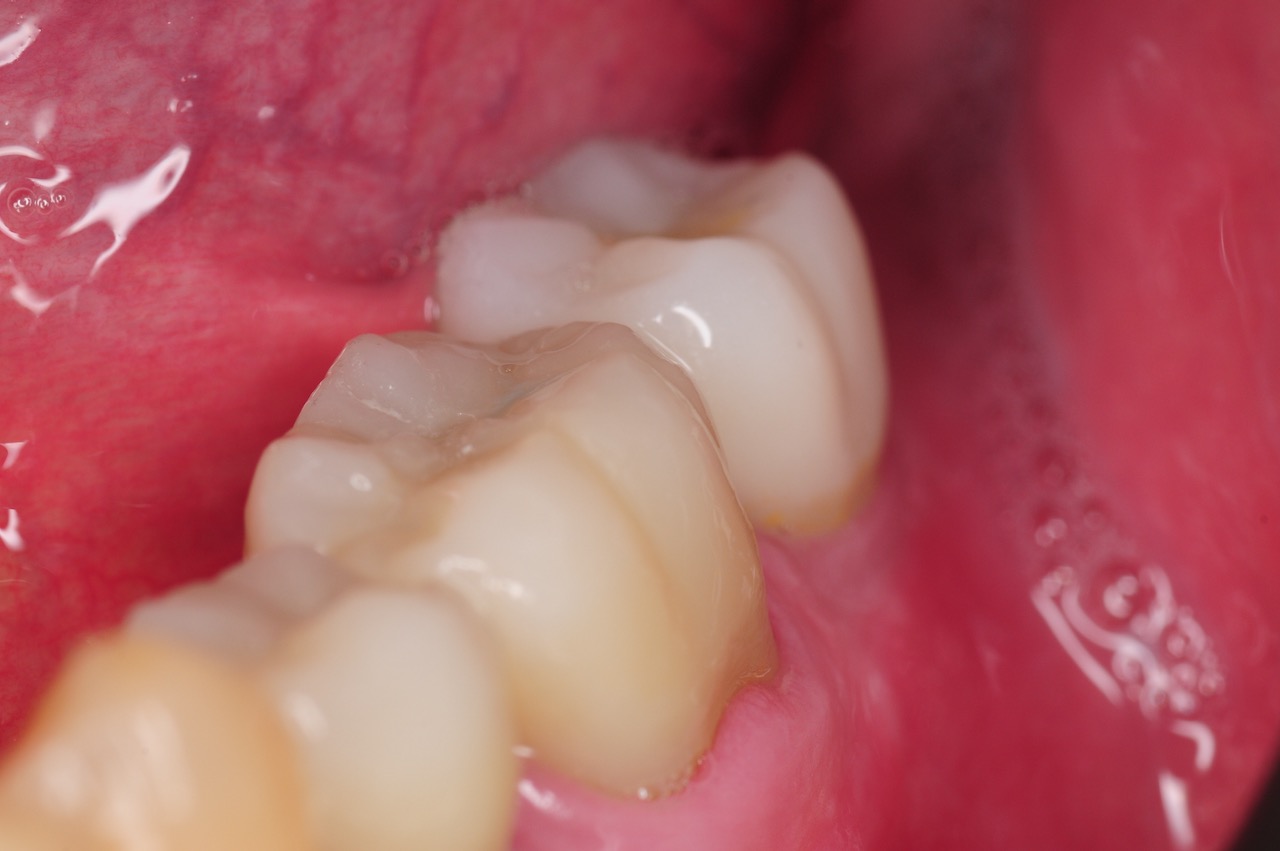 5.-Molar-dental-implant-digital-dentistry-kazemi-oral-surgery-bethesda-MD