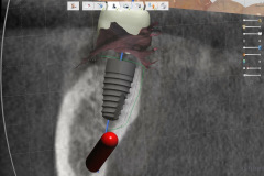 2.-Molar-dental-implant-digital-dentistry-kazemi-oral-surgery-bethesda-MD