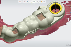3.-Molar-dental-implant-digital-dentistry-surgical-guide-kazemi-oral-surgery-bethesda-MD