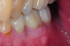 4.-Molar-dental-implant-digital-dentistry-kazemi-oral-surgery-bethesda-MD