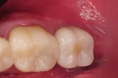 6.-Molar-dental-implant-digital-dentistry-kazemi-oral-surgery-bethesda-MD