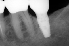 7.-Molar-dental-implant-digital-dentistry-kazemi-oral-surgery-bethesda-MD