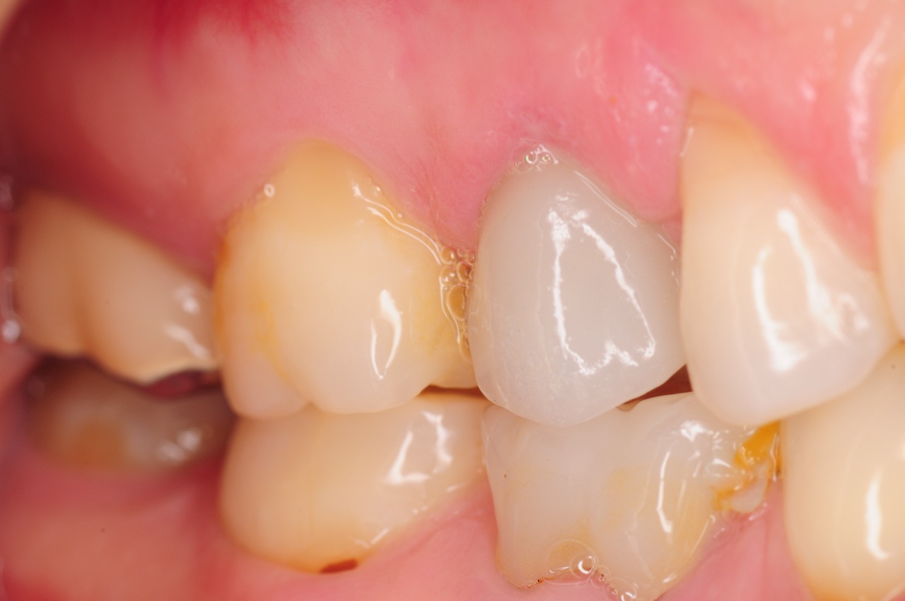 4.-maryland-bridge-to-dental-implant-crown-kazemi-oral-surgery-gray-giannini