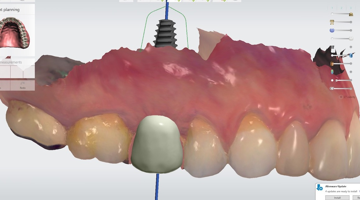 2.-maryland-bridge-to-dental-implant-digital-plan-kazemi-oral-surgery-gray-giannini