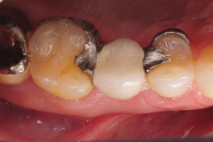 1.-maryland-bridge-to-dental-implant-kazemi-oral-surgery-gray-giannini