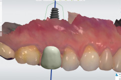 2.-maryland-bridge-to-dental-implant-digital-plan-kazemi-oral-surgery-gray-giannini
