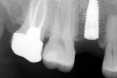 3.-maryland-bridge-to-dental-implant-xray-kazemi-oral-surgery-gray-giannini