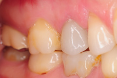 4.-maryland-bridge-to-dental-implant-crown-kazemi-oral-surgery-gray-giannini