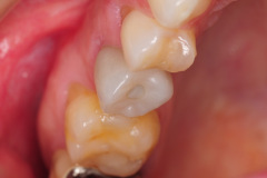4.-maryland-bridge-to-dental-implant-restoration-final-kazemi-oral-surgery-gray-giannini