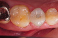 5.-maryland-bridge-to-dental-implant-restoration-kazemi-oral-surgery-gray-giannini