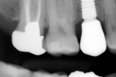 6.-maryland-bridge-to-dental-implant-final-xray-kazemi-oral-surgery-gray-giannini