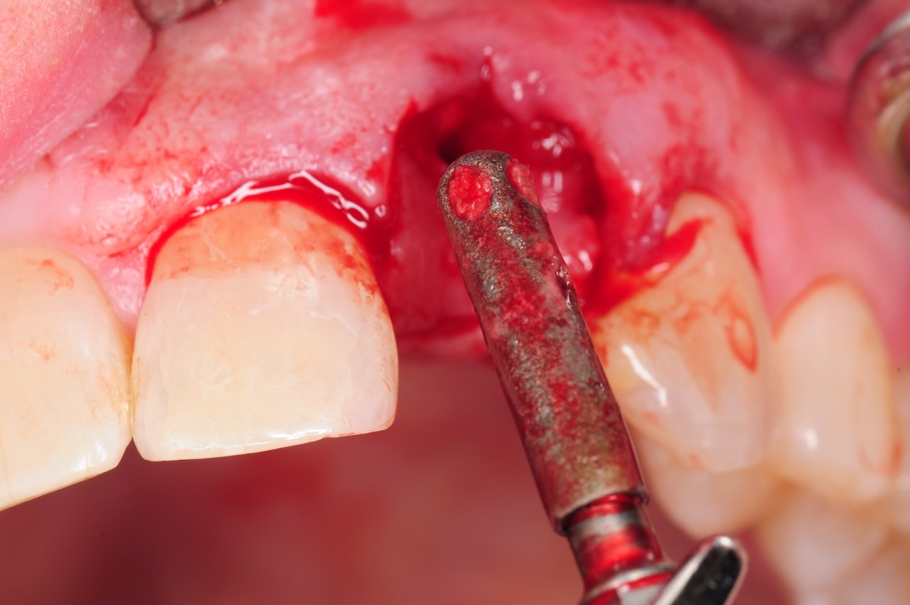 10.-dental-implant-gum-recession-peri-implantitis-infection-poorly-placed-kazemi-oral-surgery-bethesda