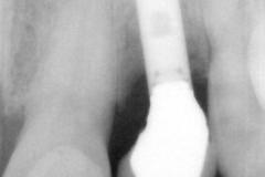 1.-dental-implant-gum-recession-peri-implantitis-infection-poorly-placed-kazemi-oral-surgery-bethesda