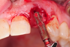10.-dental-implant-gum-recession-peri-implantitis-infection-poorly-placed-kazemi-oral-surgery-bethesda