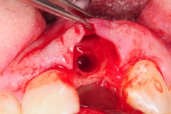 13.-dental-implant-gum-recession-peri-implantitis-infection-poorly-placed-kazemi-oral-surgery-bethesda