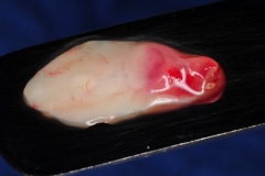 14.-dental-implant-gum-recession-peri-implantitis-infection-poorly-placed-kazemi-oral-surgery-bethesda-platelet-rich-fibrin-PRF