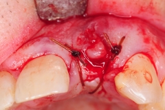 15.-dental-implant-gum-recession-peri-implantitis-infection-poorly-placed-kazemi-oral-surgery-bethesda