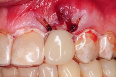 16.-dental-implant-gum-recession-peri-implantitis-infection-poorly-placed-kazemi-oral-surgery-bethesda