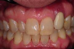2.-dental-implant-gum-recession-peri-implantitis-infection-poorly-placed-kazemi-oral-surgery-bethesda