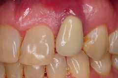 3.-dental-implant-gum-recession-peri-implantitis-infection-poorly-placed-kazemi-oral-surgery-bethesda