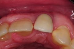 4.-dental-implant-gum-recession-peri-implantitis-infection-poorly-placed-kazemi-oral-surgery-bethesda