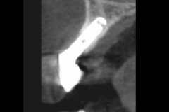 5.-dental-implant-gum-recession-peri-implantitis-infection-poorly-placed-kazemi-oral-surgery-bethesda