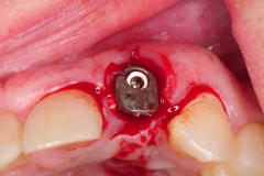 6.-dental-implant-gum-recession-peri-implantitis-infection-poorly-placed-kazemi-oral-surgery-bethesda