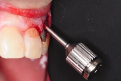 7.-dental-implant-gum-recession-peri-implantitis-infection-poorly-placed-kazemi-oral-surgery-bethesda