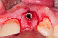 8.-dental-implant-gum-recession-peri-implantitis-infection-poorly-placed-kazemi-oral-surgery-bethesda