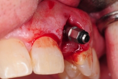 9.-dental-implant-gum-recession-peri-implantitis-infection-poorly-placed-kazemi-oral-surgery-bethesda